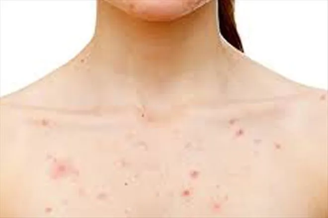 Vücutta Çıkan Sivilceleri Geçirmek İçin Neler Yapılabilir?