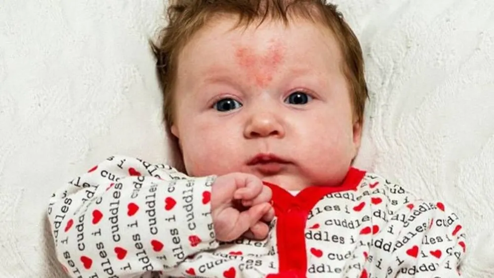 Çocukların Yüzündeki Şekerleme Lekeleri: Nasıl Gider?